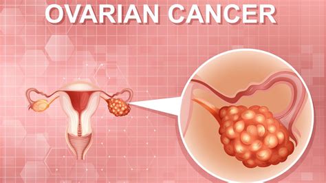 Ovarian Cancer Day Know About The Warning Signs Are Women Over 30 At Risk