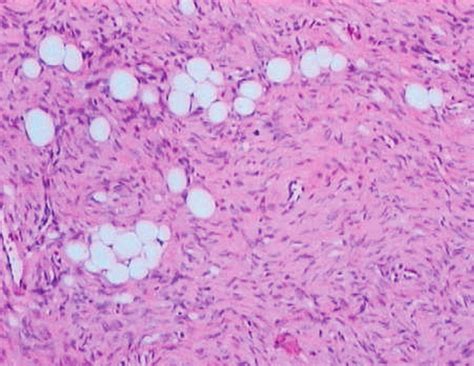 Dermatofibrossarcoma Protuberante Neoplasia Fusocelular Padr O