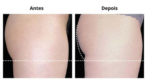 Sculptra No Glúteo Antes E Depois