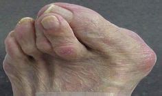 Hammertoes - Symptoms,Causes and Treatment http://www.kazmerfootandanklecenters.com/services ...