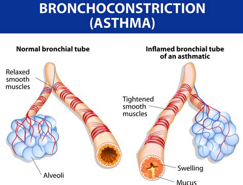 Dyspnea Wheezing And Coughing Pediatric Pulmonologists