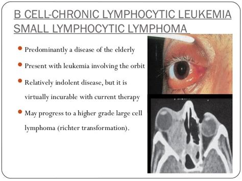 Ocular Lymphoma