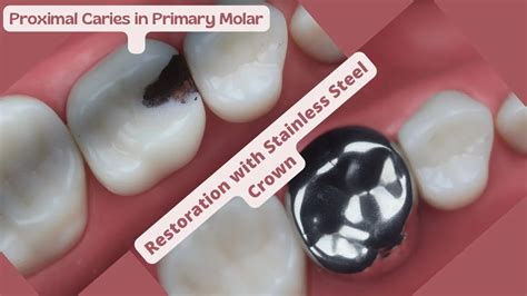 Buy 3M Espe SS Crown Primary Molar Crown D 1st Molar At Best Price