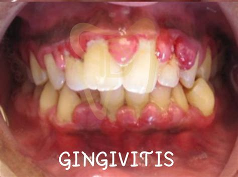 Unlocking The Secrets Of Gingivitis A Comprehensive Guide Dev Dontics