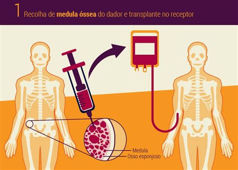 Transplante de medula óssea um novo e grande incentivo Observador