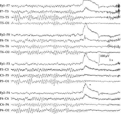 2 Subject Is Awake And Resting Normal Posterior Alpha Rhythm