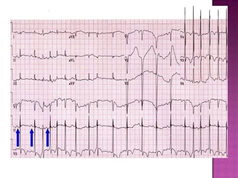 ECG: Multifocal Atrial Tachycardia