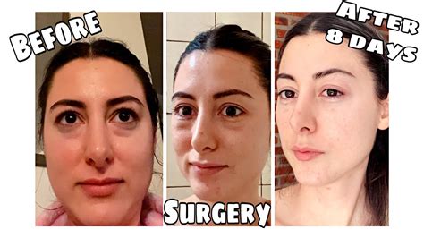 First Week Of Blepharoplasty Recovery Youtube