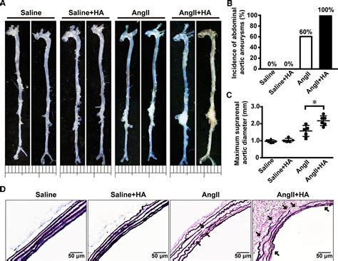 Runx2 Runt Related Transcription Factor 2 Mediated Microcalcification