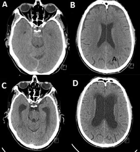 Hydrocephalous As A Complication Of Perimesencephalic Nonaneurysmal