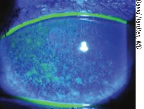 Corneal Staining Dry Eye