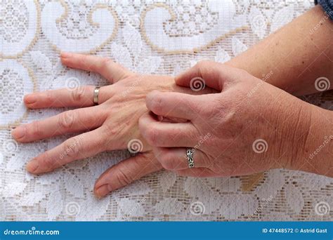 Dry Itchy Skin Stock Photo - Image: 47448572