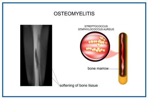 Ostéomyélite Infection Osseuse Types Symptômes Causes Diagnostic