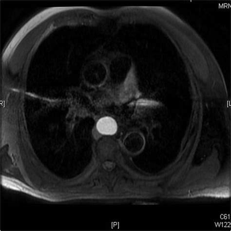 Foregut Duplication Cyst Image Radiopaedia Org