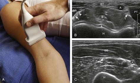 Elbow Ultrasound | Ultrasound, Diagnostic medical sonography, Radiology imaging