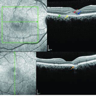 Follow Up Spectral Domain Optical Coherence Tomography Showing