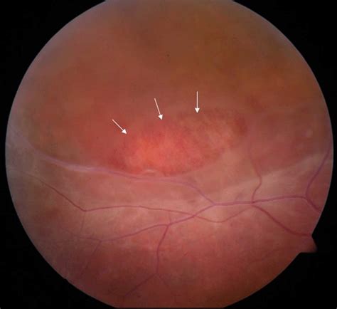 Retinoschisis causes, symptoms, diagnosis & retinoschisis treatment