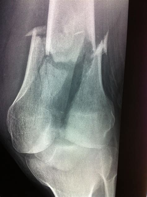 Femur Fracture Distal Knee