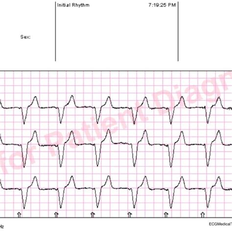 Paramedics Can And Should Become Experts In Lead Ecg Interpretation