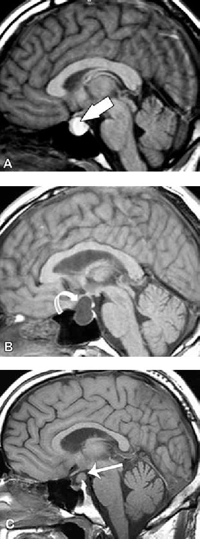 Figure 1 From Rathke Cleft Cyst Mri Criteria For Presumptive Diagnosis