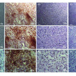 Immunohistochemical Analysis Of ALDH Positive Cells In Five Cases Of