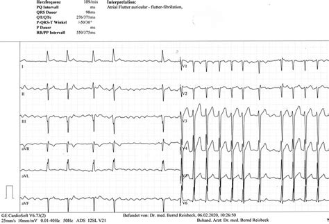 Atrial Flutter Diagnosis And Treatments Marbella