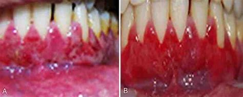 A Swollen And Erythematous Gingiva With Diffuse Epithelial Sloughing