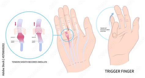 palm lump muscle examine hand cyst flexor pain anatomy medical and ...