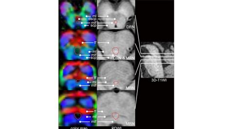 Identification of the dorsal raphe nucleus (DRN) and median raphe ...