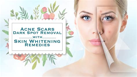 Acne Scars Dark Spot Removal With Skin Whitening Remedies Youtube