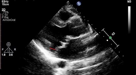 Disyunci N De Anillo Mitral En Pacientes Con Insuficiencia Mitral