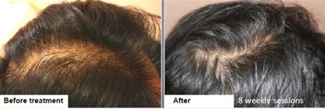 Hair And Scalp Treatment Dermaroller® Micro Needling Collagen