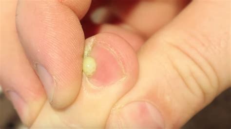 Infected Cuticle Pop Youtube