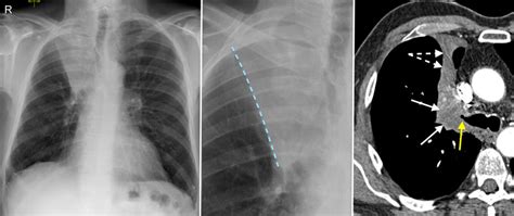 Right upper lobe collapse - CXR/CT - Radiology at St. Vincent's University Hospital