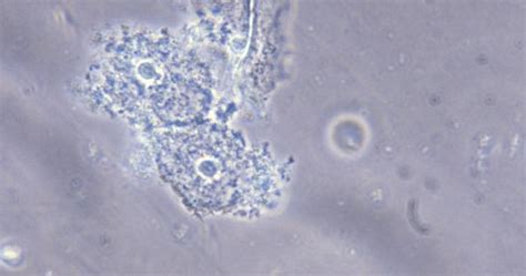 Pengertian Candidiasis Vaginalis Jurnal Bidan Diah