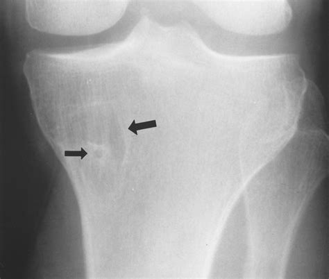 Radiologic Pathologic Correlation Of Intraosseous Lipomas Ajr