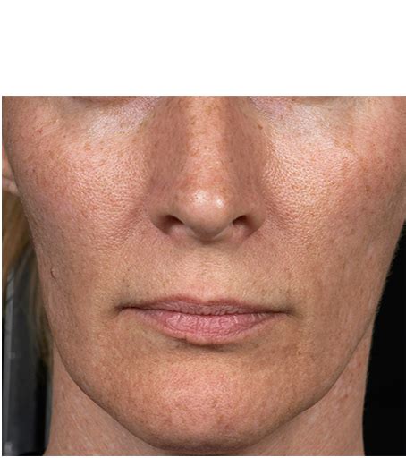 Fraxel Skin Resurfacing Treatment