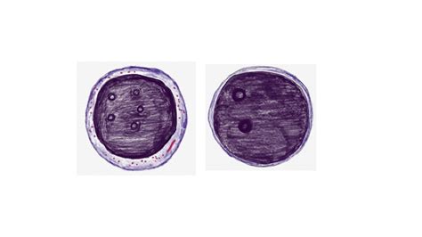 MYELOBLAST Vs LYMPHOBLAST - Pathology Made Simple