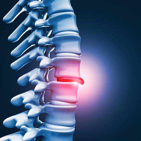 Signs You May Have A Herniated Disc And How Disc Fx Can Help