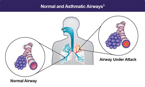 What is Asthma? – Asthma Patient & Caregiver