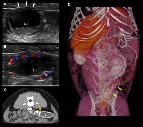 Abdominal Ultrasound Anatomy Image