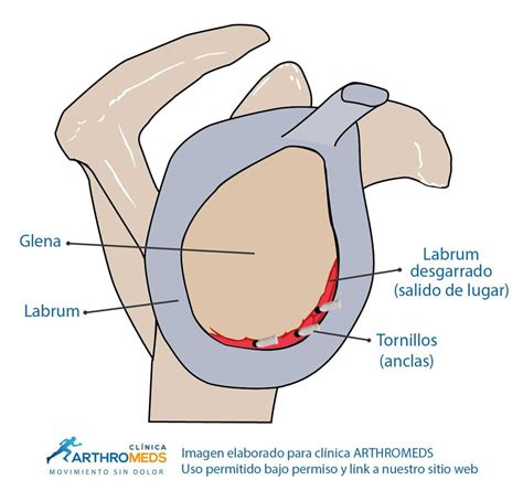 Artroscopia de hombro para reparación labrum desgarrado