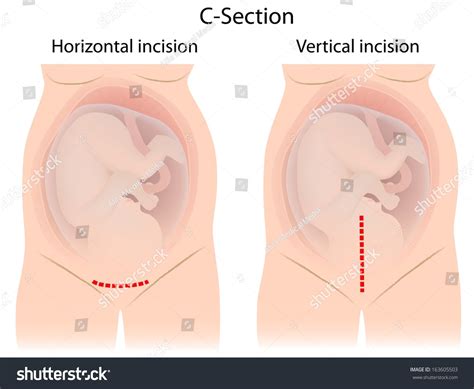 Types Incisions Cesarean Delivery Stock Illustration 163605503