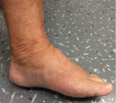 Top 99 Pictures Pictures Of Cellulitis On Foot Latest