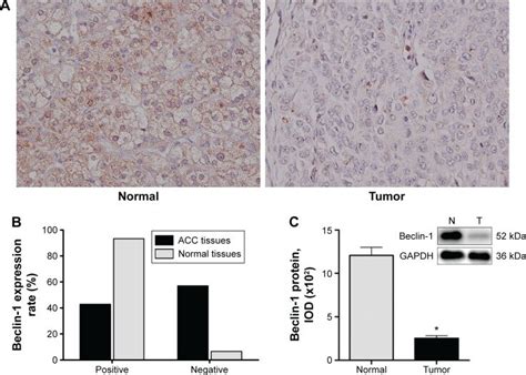 Beclin 1 Expression In Human Acc And Normal Adrenocortical Tissues