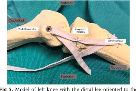 Figure 5 From Modified Bosworth Technique For Medial Collateral Ligament Reconstruction Of The