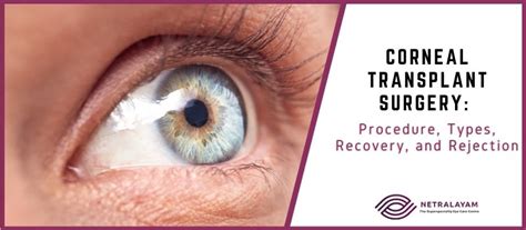 Corneal Transplant Surgery Procedure Types Recovery And Rejection