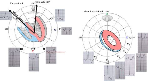 Figure From Left Septal Fascicular Block Following Alcohol Septal