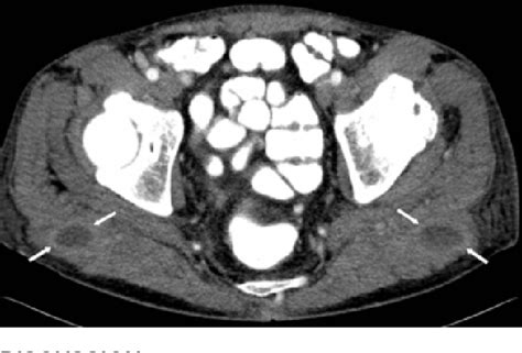 Figure 1 From Bilateral Sterile Gluteal Abscesses Following