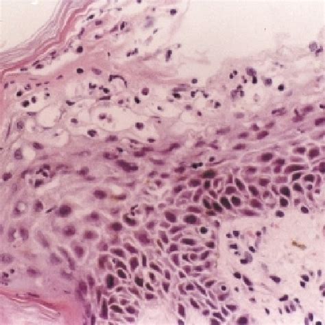 Pdf Necrolytic Migratory Erythema Associated With Glucagonoma